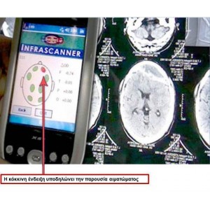 Φορητή συσκευή εντοπισμού ενδοκρανιακού αιματώματος InfraScanner InfraScan