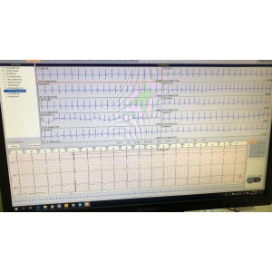 Holter Ρυθμού ECG Holter Patch Borsam