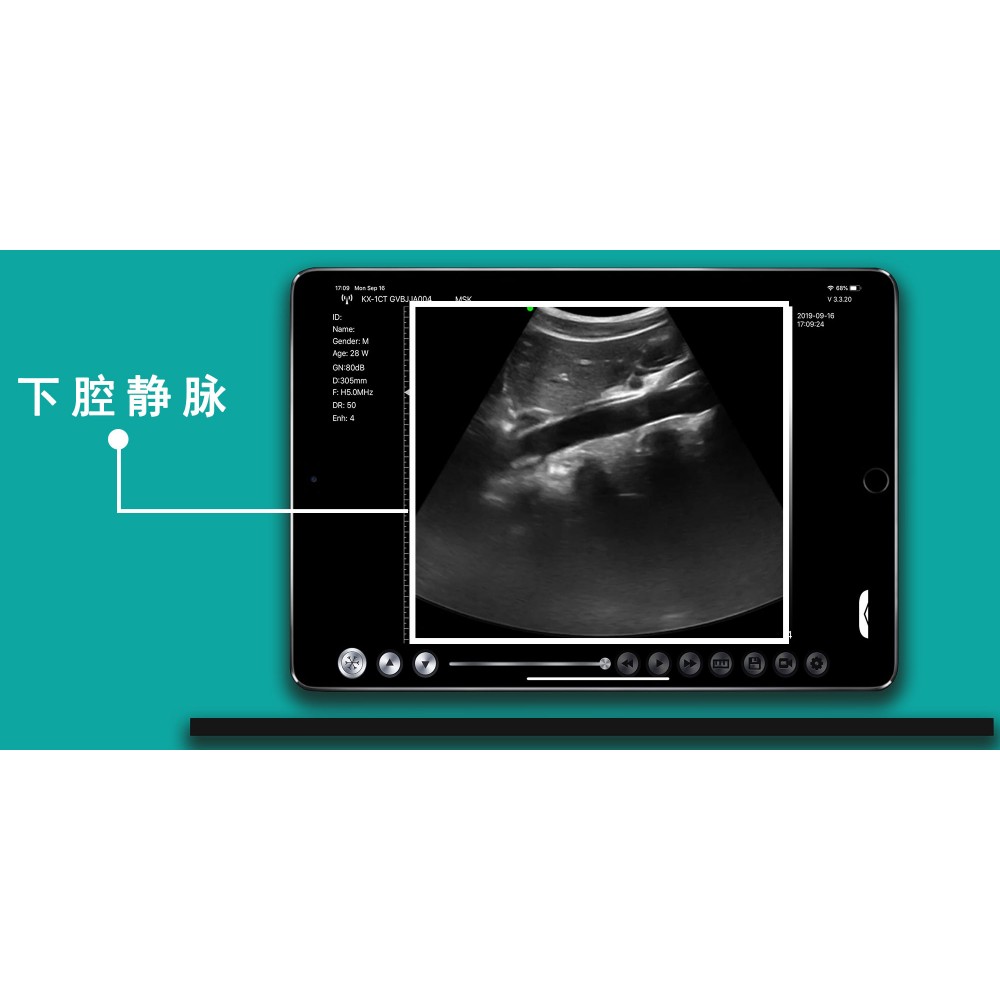Υπέρηχος Χειρός 3 σε 1 Linear/Convex/Cardiac Ασύρματος Viatom C10