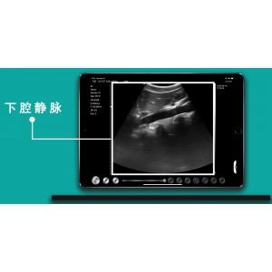 Υπέρηχος Χειρός 3 σε 1 Linear/Convex/Cardiac Ασύρματος Viatom C10