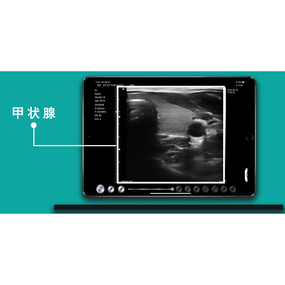 Υπέρηχος Χειρός 3 σε 1 Linear/Convex/Cardiac Ασύρματος Viatom C10