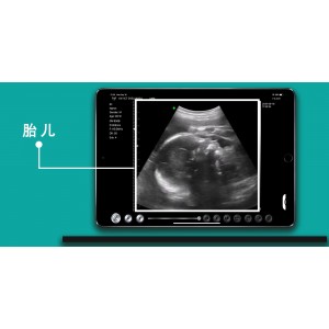 Υπέρηχος Χειρός 3 σε 1 Linear/Convex/Cardiac Ασύρματος Viatom C10